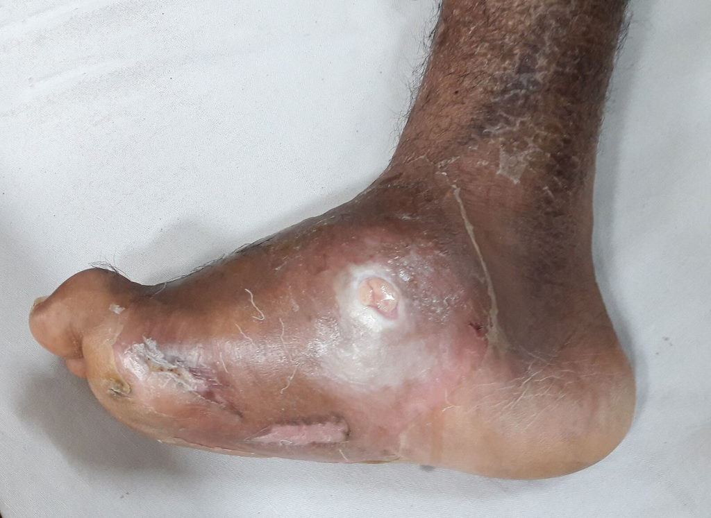 siren-socks-charcot-foot