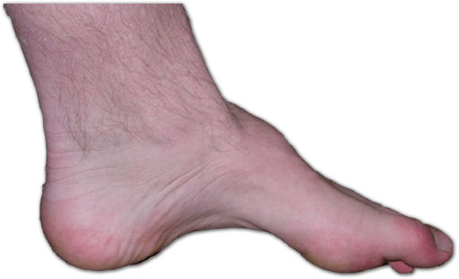 charcot-marie-tooth